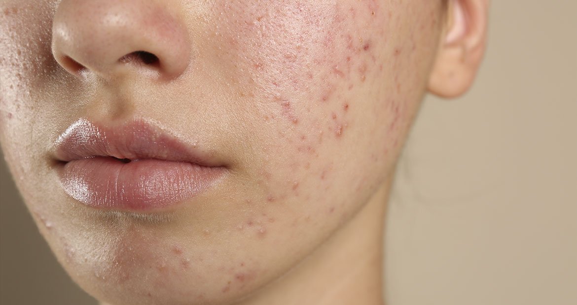 mulher branca com diversas lesões de acne no rosto